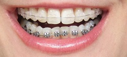 Clear teenager braces