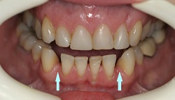 Cosmetic Makeover with Porcelain teeth